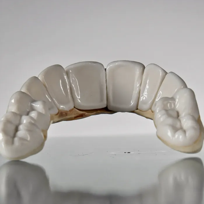 Dental veneers